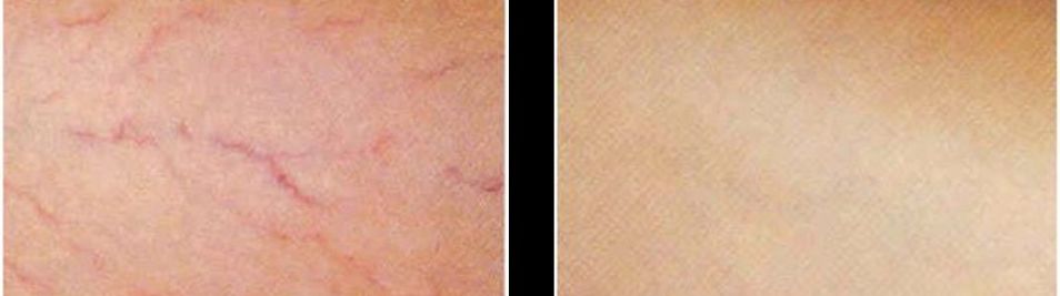 Vein Removal by LASER